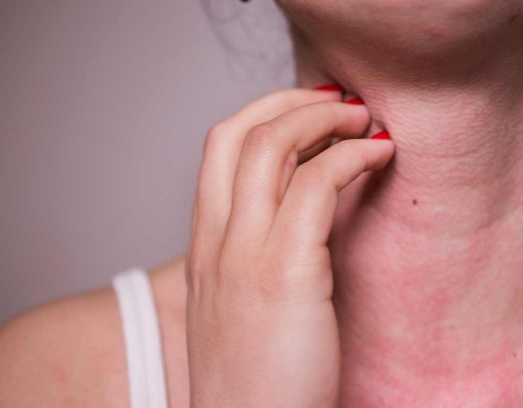 urticaria e angioedema